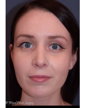 After Image: Rhinoplasty – Open