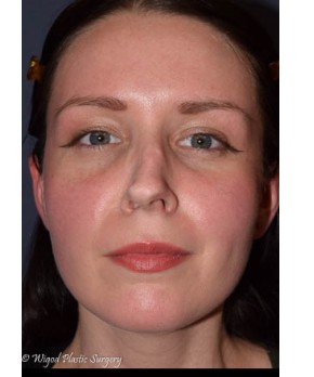 Before Image: Rhinoplasty – Open