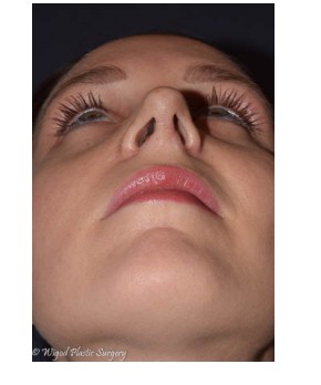 Rhinoplasty – Open