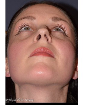 Rhinoplasty – Open