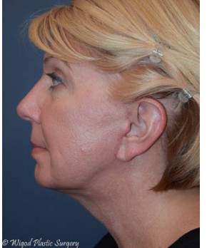 Facial Rejuvenation – Facelift and Fat Grafting