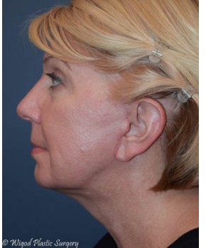 Facial Rejuvenation – Facelift and Fat Grafting