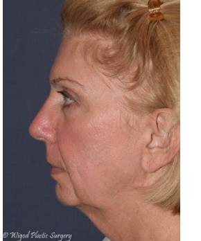 Facial Rejuvenation – Facelift and Fat Grafting