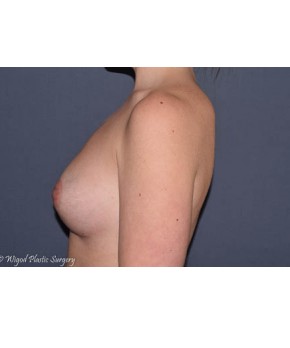 Breast Augmentation After Pregnancy Volume Loss