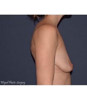 Breast Augmentation Ptotic (Sagging) Breasts