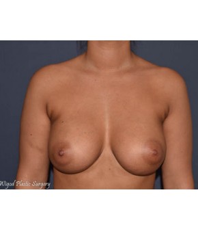 After Image: Breast Augmentation – Dense Breasts - front