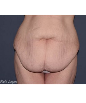 Before Image: Massive Weight Loss – Abdominoplasty