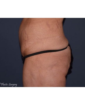 Massive Weight Loss – Abdominoplasty