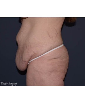 Massive Weight Loss – Abdominoplasty