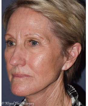 Facial Rejuvenation – Facelift