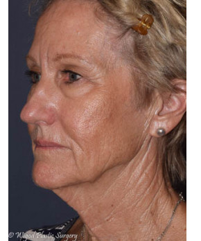 Facial Rejuvenation – Facelift