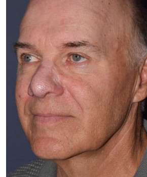 Rhinoplasty – Rhinophyma