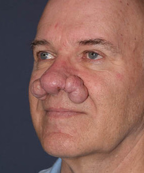 Rhinoplasty – Rhinophyma
