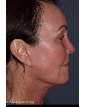 Facial Rejuvenation – Facelift and Browlift staged