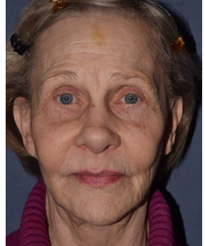 Rhinoplasty – Open with Cheek Implant