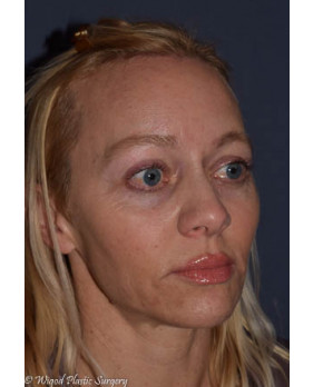 After Image: Facial Rejuvenation – Brow Lift - other