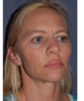 Before Image: Facial Rejuvenation – Brow Lift - other