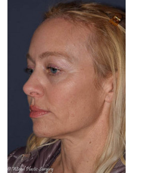 Facial Rejuvenation – Brow Lift
