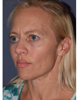 Facial Rejuvenation – Brow Lift