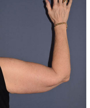 Massive Weight Loss – Brachioplasty
