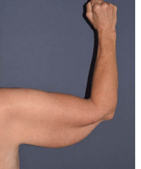 Massive Weight Loss – Brachioplasty