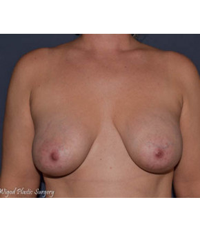 After Image: Breast Augmentation Ptotic (Sagging) Breasts - front
