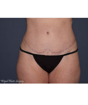 After Image: Abdominoplasty with Flank Liposuction