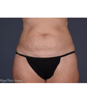Abdominoplasty with Flank Liposuction