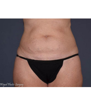 Before Image: Abdominoplasty with Flank Liposuction