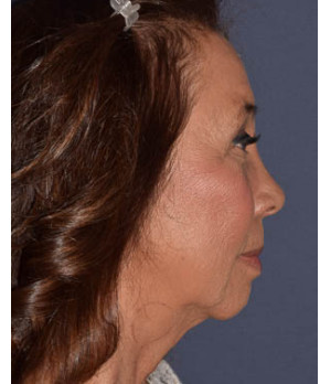Facial Rejuvenation – Browlift with Fat Grafting