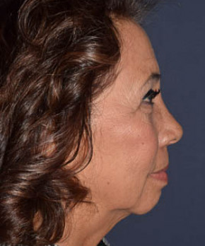 Facial Rejuvenation – Browlift with Fat Grafting