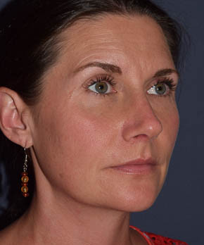 After Image: Rhinoplasty – Open with Functional Airway - other