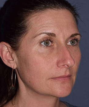 Before Image: Rhinoplasty – Open with Functional Airway - other