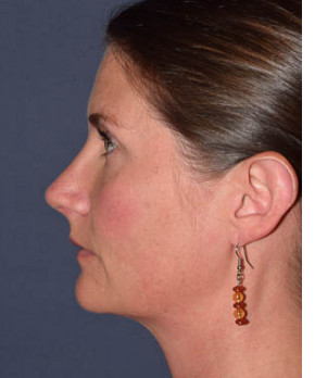 Rhinoplasty – Open with Functional Airway