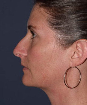 Rhinoplasty – Open with Functional Airway