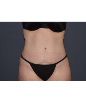After Image: Abdominoplasty with Flank Liposuction