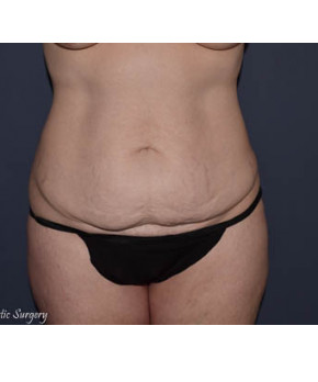 Before Image: Abdominoplasty with Flank Liposuction