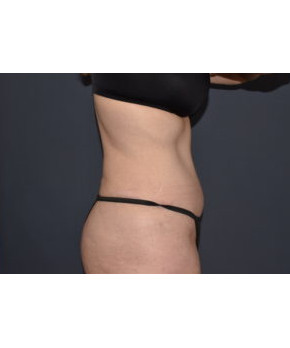 Abdominoplasty with Flank Liposuction