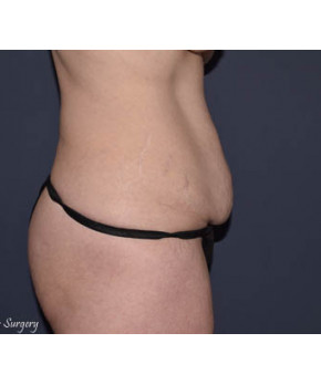 Abdominoplasty with Flank Liposuction