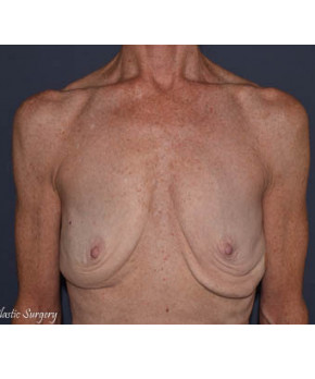 Breast Augmentation Revision with Mesh Support Mastopexy