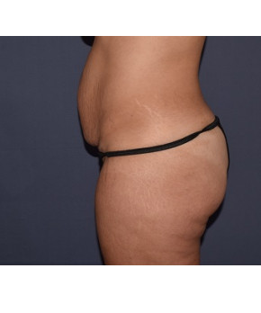 Abdominoplasty