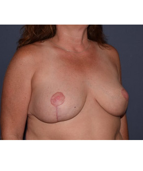 After Image: Mastopexy - other