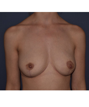 After Image: Mastopexy - front