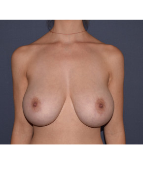 Before Image: Mastopexy - front