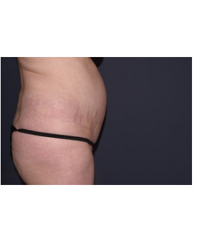 Mini Abdominoplasty with Flank Liposuction
