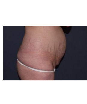 Mini Abdominoplasty with Flank Liposuction
