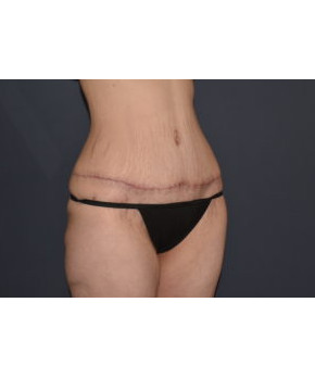 Abdominoplasty with Flank Liposuction