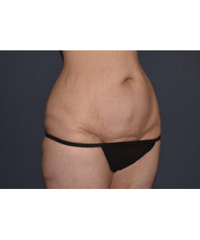 Abdominoplasty with Flank Liposuction