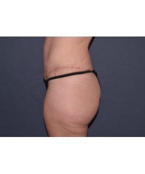 Mommy Makeover 3 – Abdominoplasty