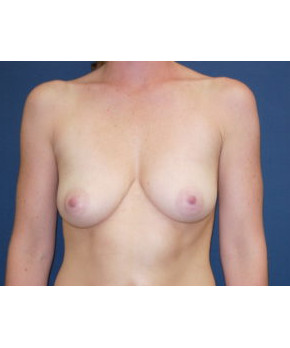 Before Image: Breast Augmentation Revision with Mesh Support - front